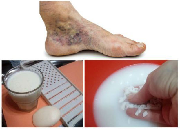Pourquoi éclate la veine sur le pied
