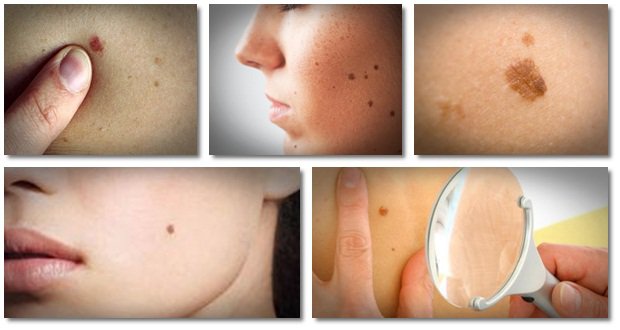 Le peeling pour les acnés
