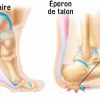 Circulaire Douleur aux Talons : Voici Comment les Soulager Circulaire Douleur aux Talons : Voici Comment les Soulager