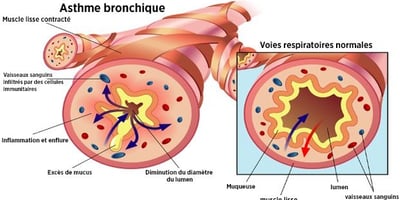 3 Remèdes qui Traitent L’asthme et Boostent le Système Respiratoire