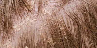4 Astuces de Grand-Mère pour Lutter Contre les Pellicules