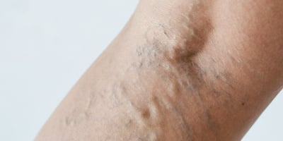 4 Astuces et Conseils pour Éviter les Varices 4 Astuces et Conseils pour Éviter les Varices