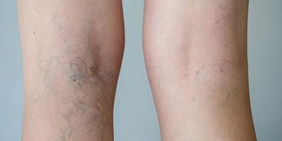 4 Astuces Naturelles pour Soigner les Varices 4 Astuces Naturelles pour Soigner les Varices