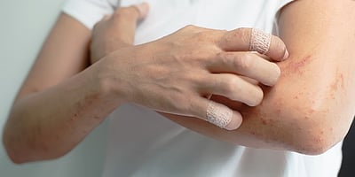 4 Remèdes Naturels Prêts en 3 Minutes pour Soigner Efficacement votre Eczéma… 4 Remèdes Naturels Prêts en 3 Minutes pour Soigner Efficacement votre Eczéma…