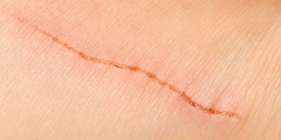 5 Remèdes Naturels Efficaces Contre les Cicatrices