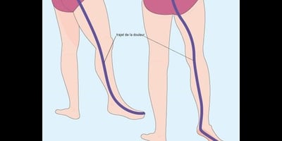 6 Méthodes Efficaces pour Soulager la Douleur Sciatique Rapidement