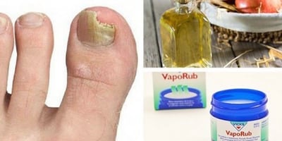 6 Remèdes Simples pour Éliminer les Champignons des Ongles