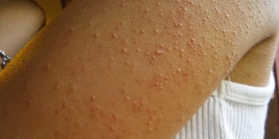 7 Signes D’intolérance au Gluten que Tout le Monde Ignore ! 7 Signes D’intolérance au Gluten que Tout le Monde Ignore !