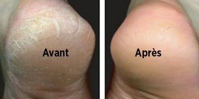 Astuce Naturelle pour Traiter les Pieds Secs et Fendillés