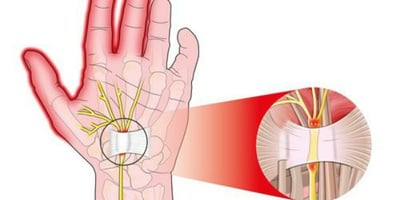Comment Traiter le Syndrome du Canal Carpien