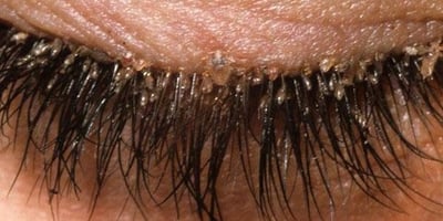 Nous avons des Acariens dans les Cils et Comment s’en Débarrasser