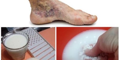 RECETTE MAGIQUE POUR LES VARICES ET THROMBOSE