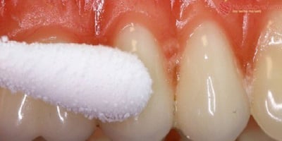 Remède Contre les Douleurs Dentaires : Efficace en 30 Minutes