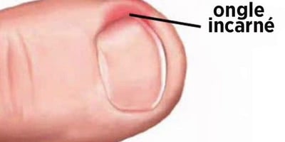 À Partir d’aujourd’hui, Vous ne Souffrirez Plus D’ongle Incarné !