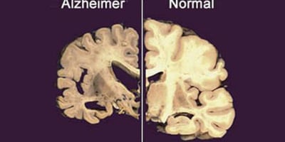 Alzheimer Serait Lié au Manque de Sommeil Alzheimer Serait Lié au Manque de Sommeil
