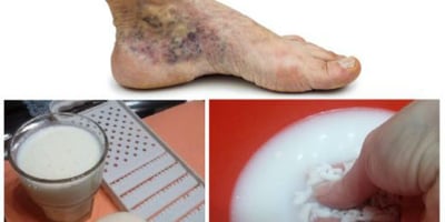 Astuces pour les Varices et Thrombose avec 2 Simples Ingrédients Astuces pour les Varices et Thrombose avec 2 Simples Ingrédients