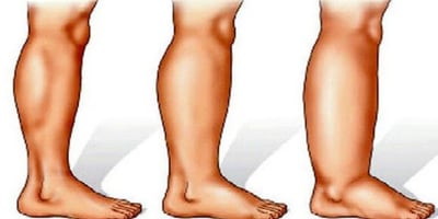 Cet Excellent Thé est le Meilleur Remède Naturel Contre les Jambes Enflées Cet Excellent Thé est le Meilleur Remède Naturel Contre les Jambes Enflées
