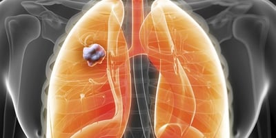 Cette Plante Détruit 86% des Cancers du Poumon et du Sein ! Cette Plante Détruit 86% des Cancers du Poumon et du Sein !