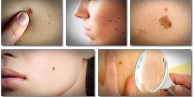 Comment Éliminer les Acrochordons de la Peau, Verrues, Tâches Brunes et Points Noirs Comment Éliminer les Acrochordons de la Peau, Verrues, Tâches Brunes et Points Noirs