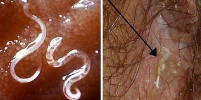 Comment Savoir si vous Avez des Parasites dans Votre Corps et vous en Débarrasser Naturellement ?
