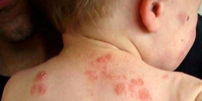 Comment se Débarrasser de L’eczéma Naturellement ?