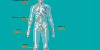 Comment Soulager L'arthrose