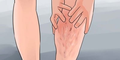Comment Traiter Naturellement les Varices ? Comment Traiter Naturellement les Varices ?