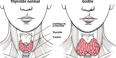 Comment un Mauvais Transit Intestinal peut Provoquer un Dérèglement de la Thyroïde