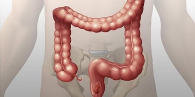 Comment vous Débarrasser d’environ 13,5 kg de Poison dans votre Colon Comment vous Débarrasser d’environ 13,5 kg de Poison dans votre Colon