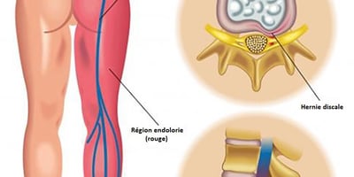 Comment vous Pouvez Soulager une Douleur Sciatique Persistante Comment vous Pouvez Soulager une Douleur Sciatique Persistante