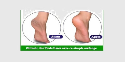 Comment obtenir des Pieds Lisses