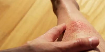 Conseils Utiles pour Contrôler L'eczéma par L'alimentation