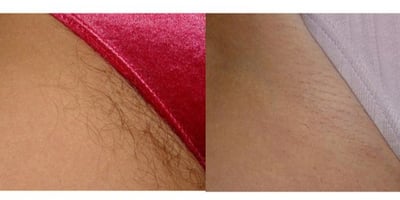 Débarrassez-vous des Poils Indésirables pour Toujours ! Débarrassez-vous des Poils Indésirables pour Toujours !