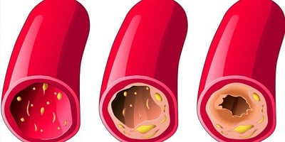 Des Aliments pour Désobstruer vos Artères de Façon Totalement Naturelle !