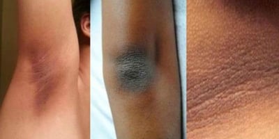 Des Astuces pour se Débarrasser de la Peau Foncée