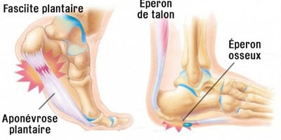 Douleur aux Talons : Voici Comment les Soulager