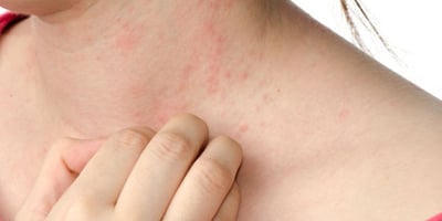 Eczéma, Comment le Soulager?