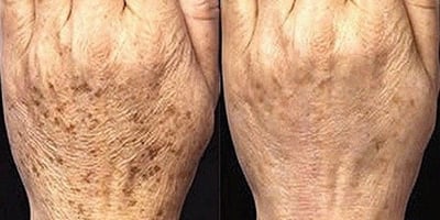 Éliminez les Taches Brunes avec le Meilleur Exfoliant Maison Éliminez les Taches Brunes avec le Meilleur Exfoliant Maison