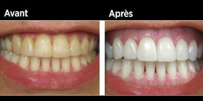 Elle a Réussi à Blanchir ses Dents et Prévenir le Tartre Grâce à ce Seul Ingrédient ! Elle a Réussi à Blanchir ses Dents et Prévenir le Tartre Grâce à ce Seul Ingrédient !