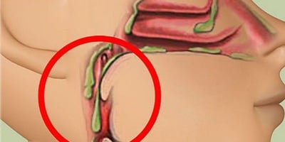 Évitez ces 4 Aliments pour Réduire le Mucus dans la Gorge Évitez ces 4 Aliments pour Réduire le Mucus dans la Gorge