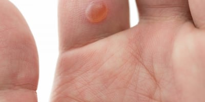 Faut-il Crever une Ampoule de Sang sur un Doigt?