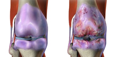 L’arthrose N’est pas Causée par l’usure du Cartilage… Méfiez-vous de la GLYCATION ! L’arthrose N’est pas Causée par l’usure du Cartilage… Méfiez-vous de la GLYCATION !