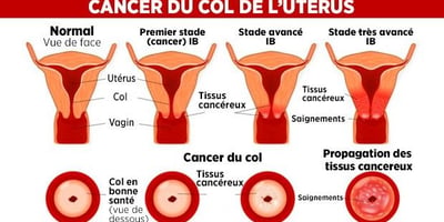Les 9 Signes de Cancer du Col de L’utérus à Connaître Les 9 Signes de Cancer du Col de L’utérus à Connaître