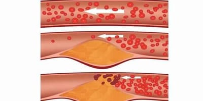 Nettoyez vos Artères Obstruées et Éliminez le Mauvais Cholestérol avec ce Remède Naturel