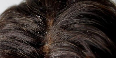 Pellicules : 4 Traitements Naturels