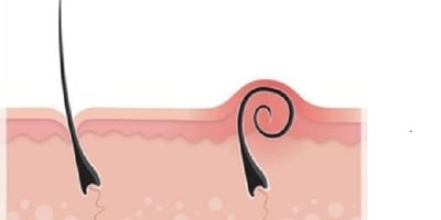 Poils Incarnés après L’épilation : Comment les Éviter ?