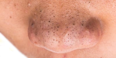 10 Trucs pour Éliminer les Points Noirs