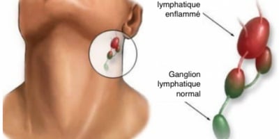 Pourquoi les Ganglions S’enflamment-ils ? Comment Traiter ce Mal ? Pourquoi les Ganglions S’enflamment-ils ? Comment Traiter ce Mal ?