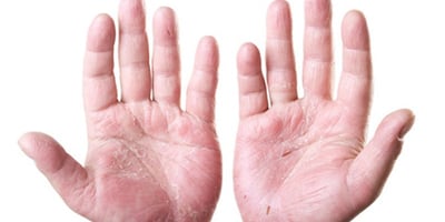 Remèdes Contre L'eczéma