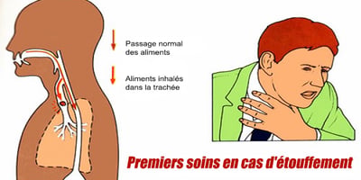 Si vous Commencez à Étouffer et que vous Êtes Seul: Sauvez Votre Vie en une Seule Seconde- VIDEO